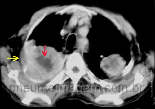 A MAIORIA DOS C�NCERES N�O SE DEVE A FATORES AMBIENTAIS OU HEREDIT�RIOS